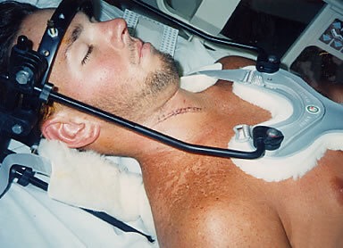 Casey Kammel at 22 in a steel halo brace in hospital, 1994, the surgical scar from the vertebral fusion visible at the base of his throat